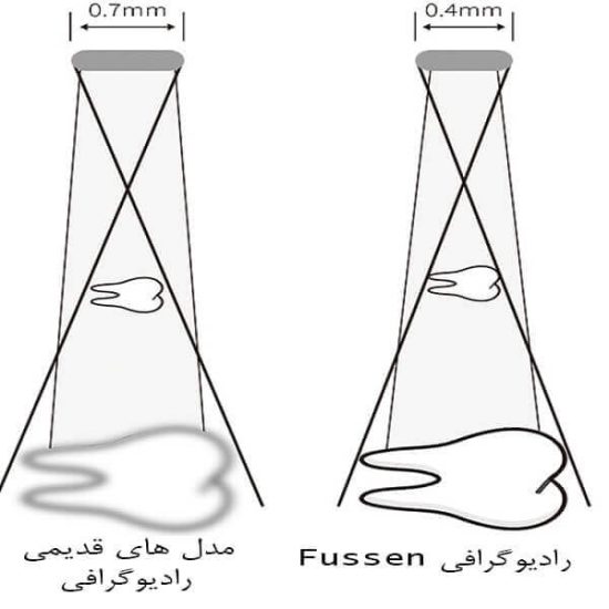 رادیوگرافی فیوژن مدل Fussen R150
