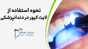 نحوه استفاده از لایت کیور در دندانپزشکی
