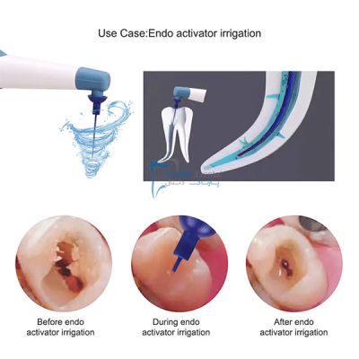 قیمت اندو اکتیویتور PRT مدل Endo Ultra Activator