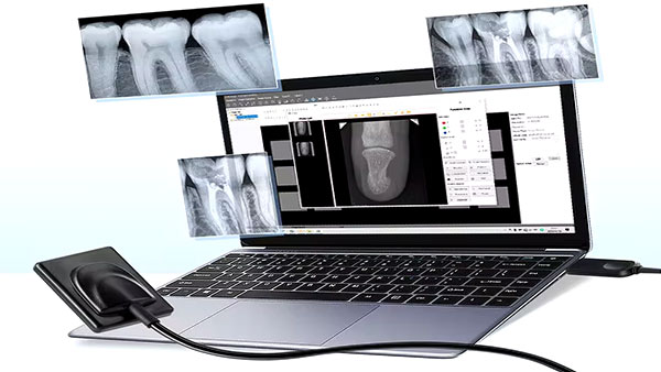 مزایای استفاده از سنسور RVG دندانپزشکی